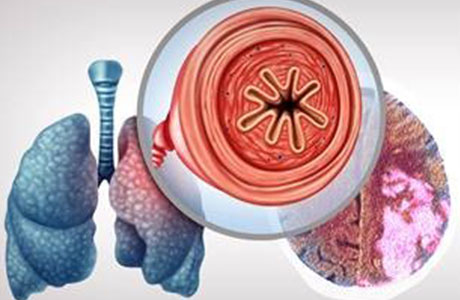 Unraveling the Relationship Between COPD and Stroke